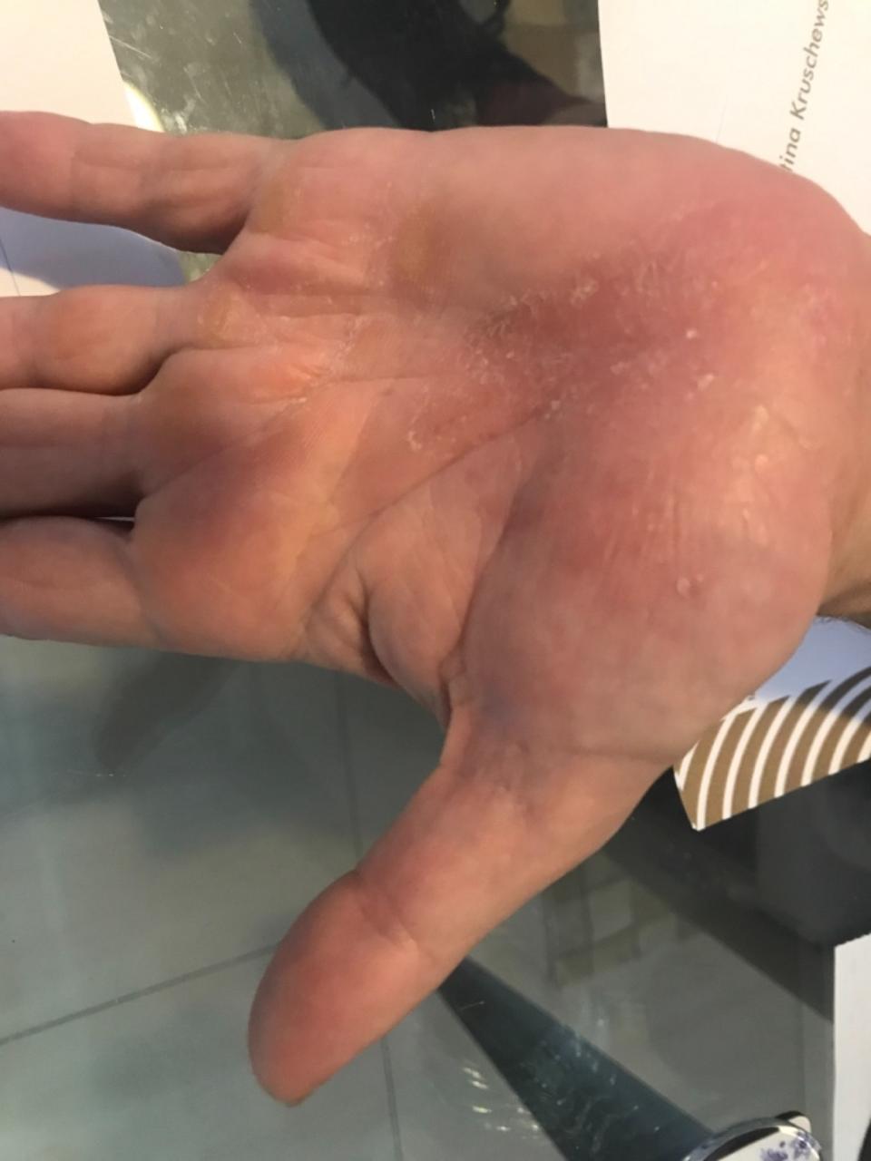 Lesão de psoríase na mão, antes do tratamento