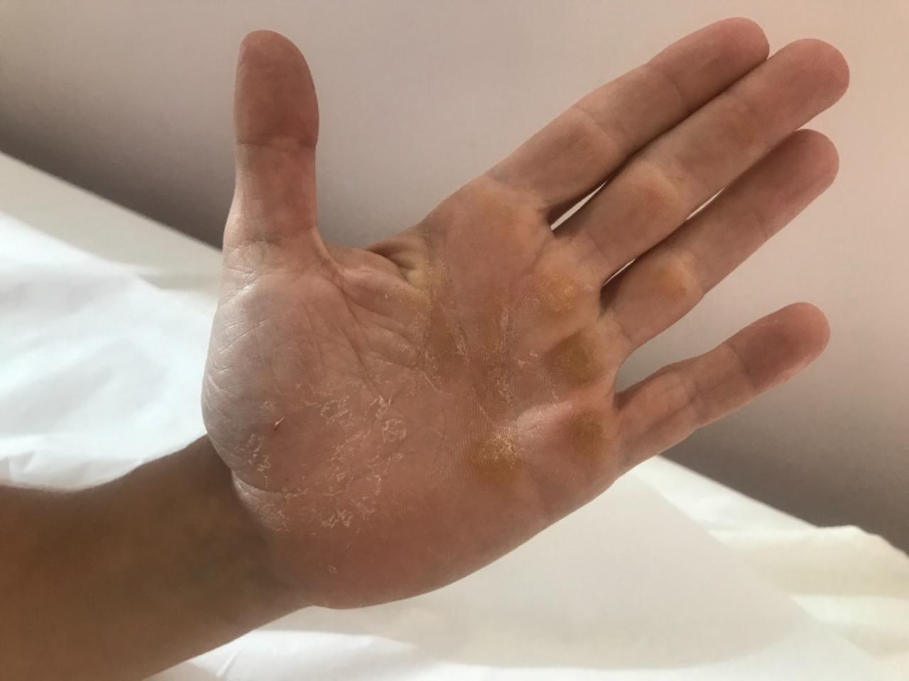 Evolução da pele da mão após o tratamento